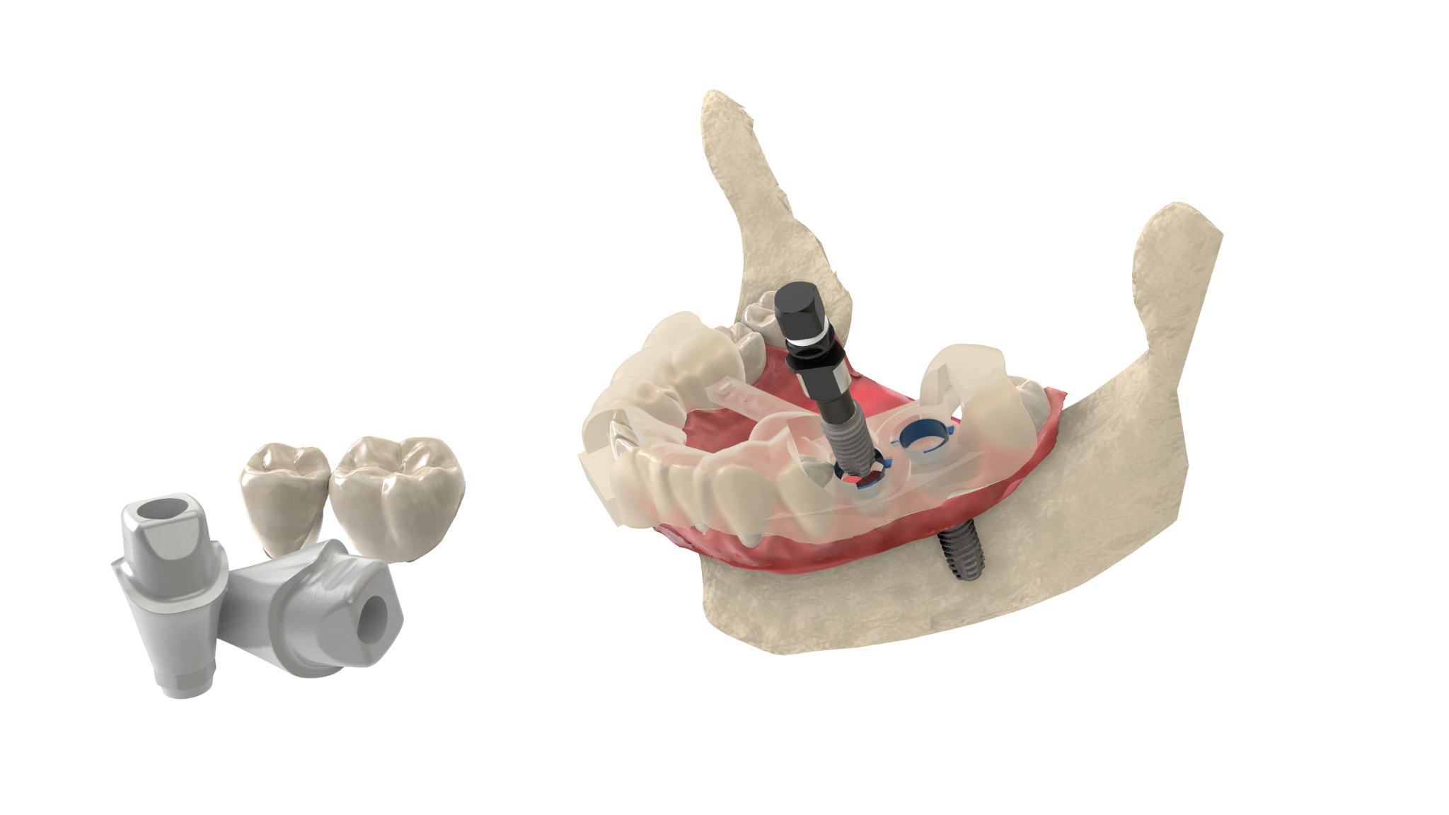Guía quirúrgica digital junto a un modelo dental